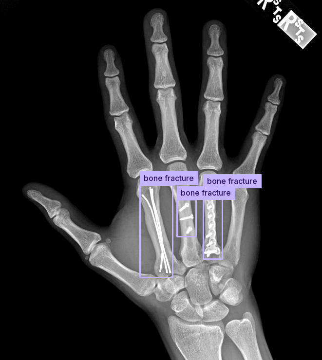 Benchmark sample: Medical (X-ray Fracture) with predicted boxes and labels
