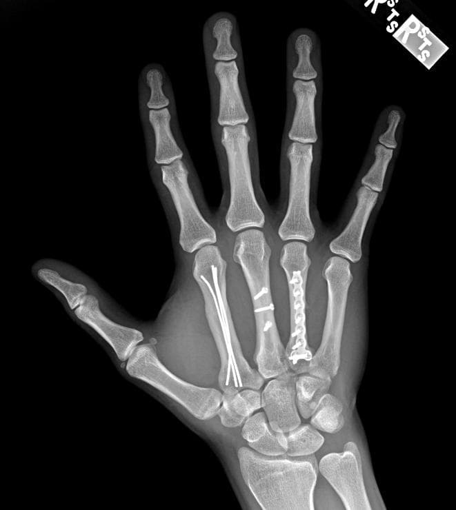 Benchmark sample: Medical (X-ray Fracture) without annotations